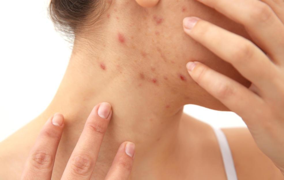 Scabies Rash On Face